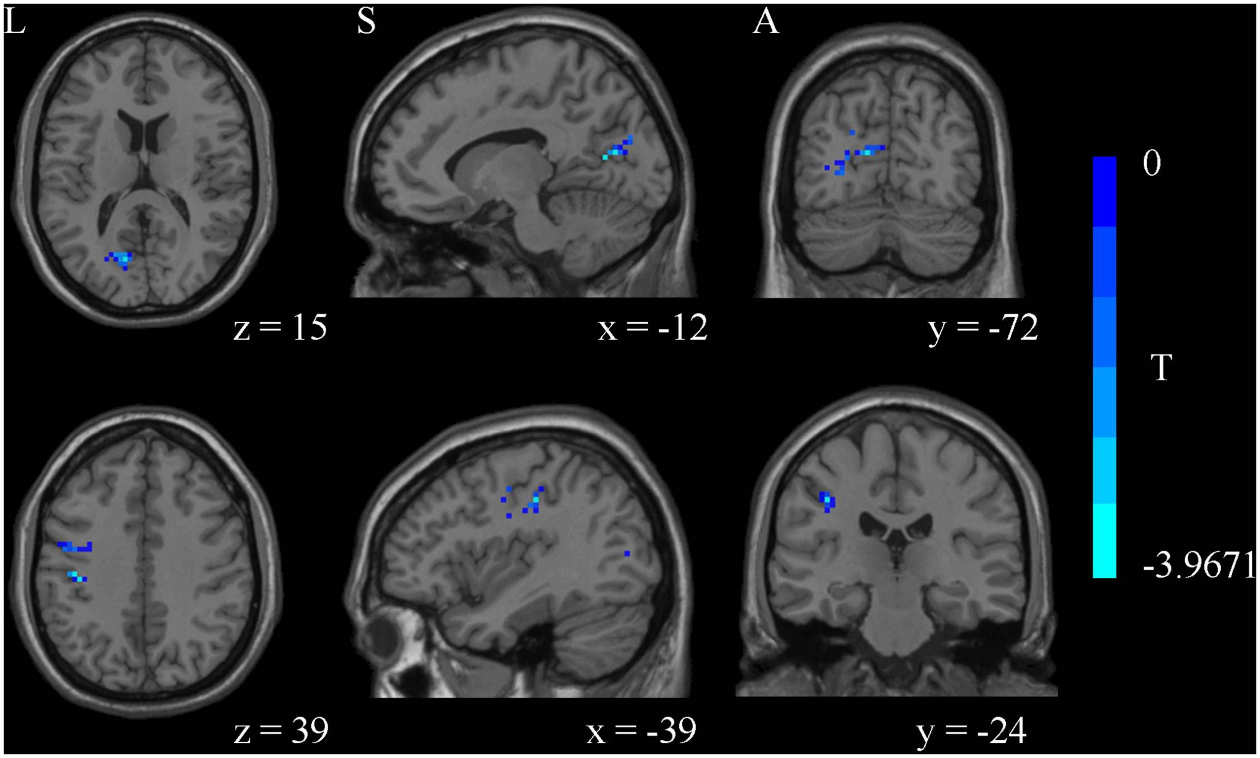 Desynchronized white matter function and structure in drug-naive first-episode major depressive disorder patients